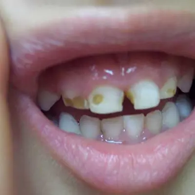 Baby teeth with severe decay and large brown spots