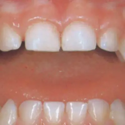 Healthy baby teeth with no spots or markings on the gums or teeth