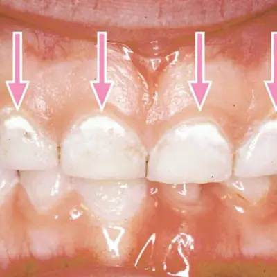 Baby teeth in very early decay with white or chalky spots near the gum line. The image has arrows pointing to these spots